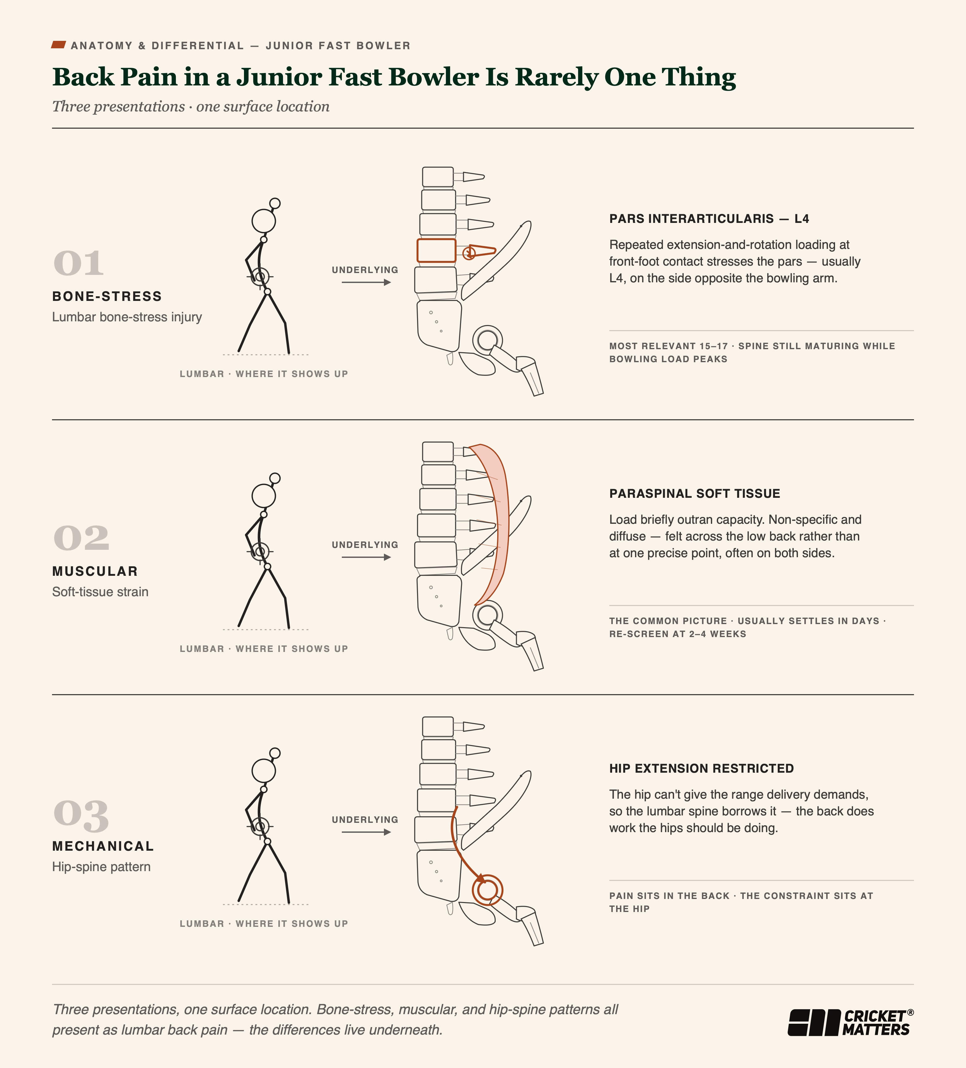 Back Pain Junior Fast Bowler